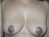 Patient # 97164 After Photo # 2