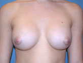Patient # 79809 After Photo # 2