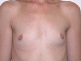 Patient # 95603 Before Photo # 1