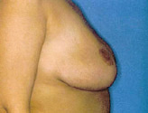 Patient # 27368 After Photo # 4