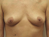 Patient # 54776 Before Photo # 1