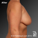 Patient # 75171 After Photo # 6