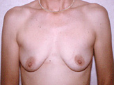 Patient # 85029 Before Photo # 1