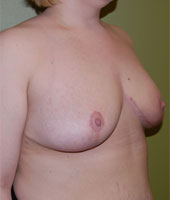 Patient # 24581 After Photo # 4