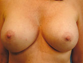 Patient # 22323 After Photo # 2