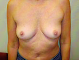Patient # 22323 Before Photo # 1