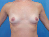 Patient # 48567 Before Photo # 1