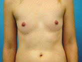 Patient # 35906 Before Photo # 1