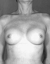 Patient # 91918 After Photo # 2