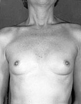 Patient # 91918 Before Photo # 1