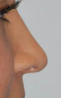 Patient # 51188 After Photo # 2
