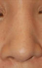 Patient # 51188 After Photo # 4