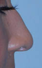Patient # 51188 Before Photo # 1