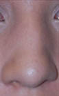 Patient # 51188 Before Photo # 3