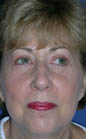 Patient # 41785 After Photo # 2