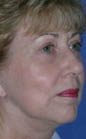 Patient # 41785 After Photo # 4