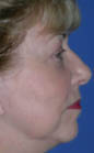 Patient # 41785 After Photo # 6