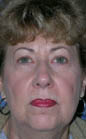 Patient # 41785 Before Photo # 1