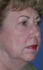 Patient # 41785 Before Photo # 3