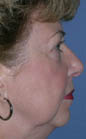 Patient # 41785 Before Photo # 5