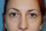 Patient # 12179 Before Photo # 1