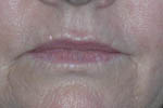 Patient # 54698 Before Photo # 1