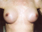 Patient # 95523 After Photo # 2