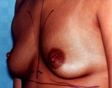 Patient # 23707 Before Photo # 1