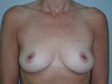 Patient # 63037 Before Photo # 1