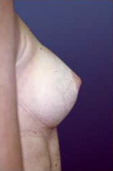 Patient # 36832 After Photo # 2
