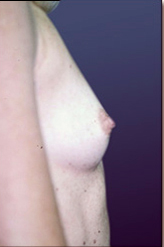 Patient # 36832 Before Photo # 1