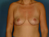 Patient # 33221 After Photo # 2