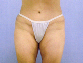 Patient # 73732 After Photo # 2