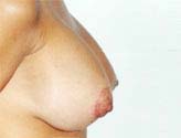 Patient # 64126 After Photo # 4