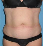 Patient # 74077 Before Photo # 1