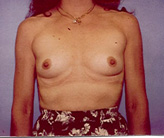 Patient # 30522 Before Photo # 1