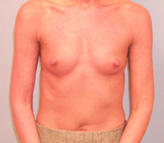 Patient # 96717 Before Photo # 1