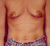 Patient # 91361 Before Photo # 1