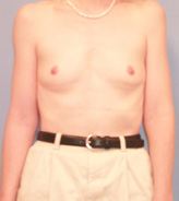 Patient # 94122 Before Photo # 1