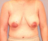 Patient # 20362 Before Photo # 1