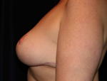 Patient # 14145 After Photo # 6