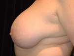 Patient # 14145 Before Photo # 5