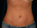 Patient # 19505 After Photo # 4