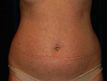 Patient # 19505 Before Photo # 3