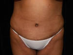 Patient # 20861 After Photo # 2