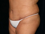 Patient # 20861 After Photo # 4
