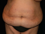 Patient # 20861 Before Photo # 1