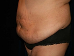 Patient # 20861 Before Photo # 3