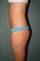 Patient # 70669 After Photo # 4