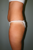 Patient # 70669 Before Photo # 3